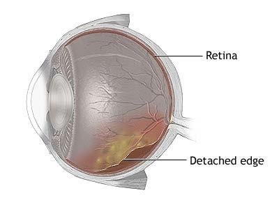 imagine cu dezlipirea de retina